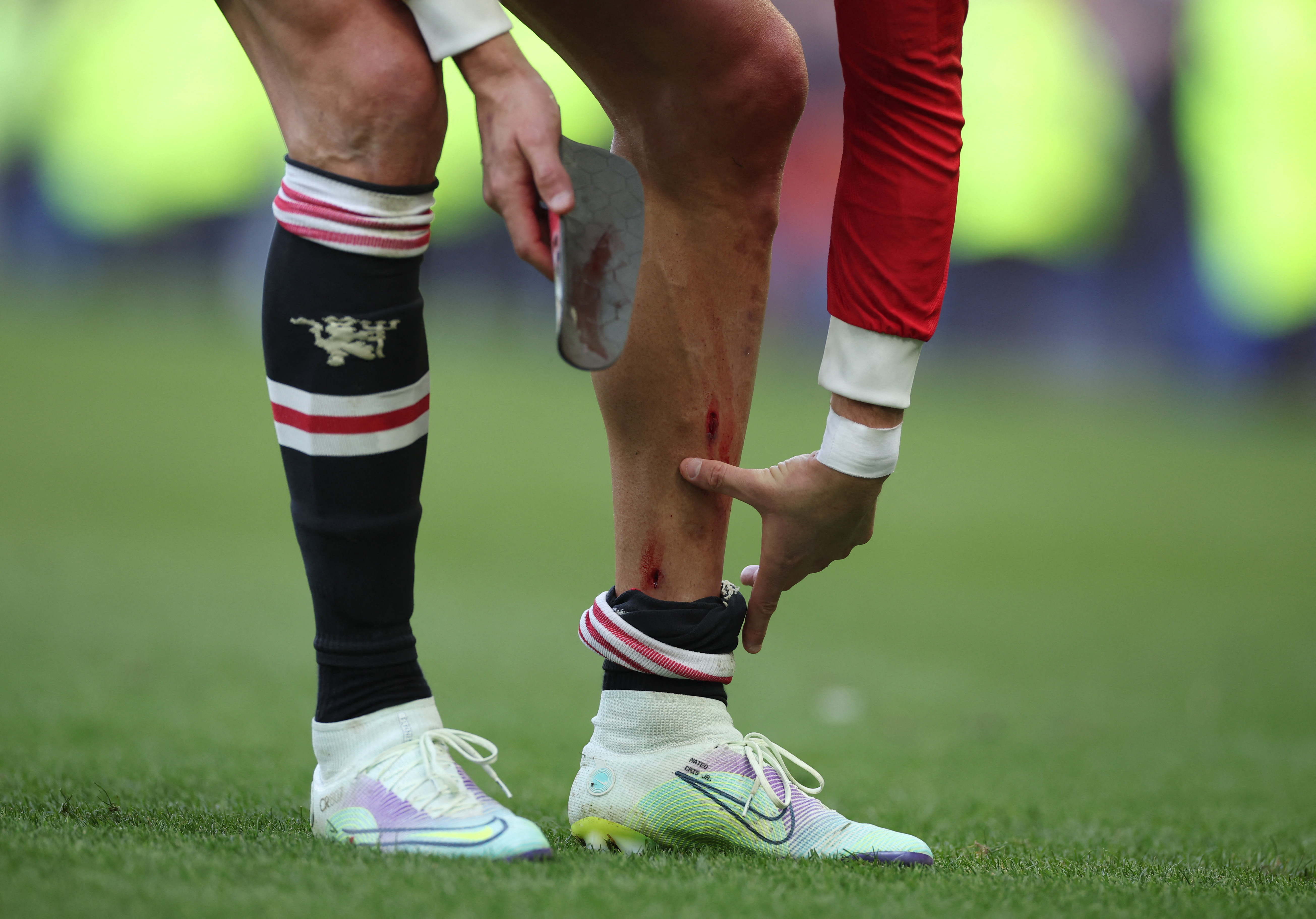 Las heridas en la pierna izquierda de Cristiano Ronaldo tras el partido contra el Everton (Foto: REUTERS)