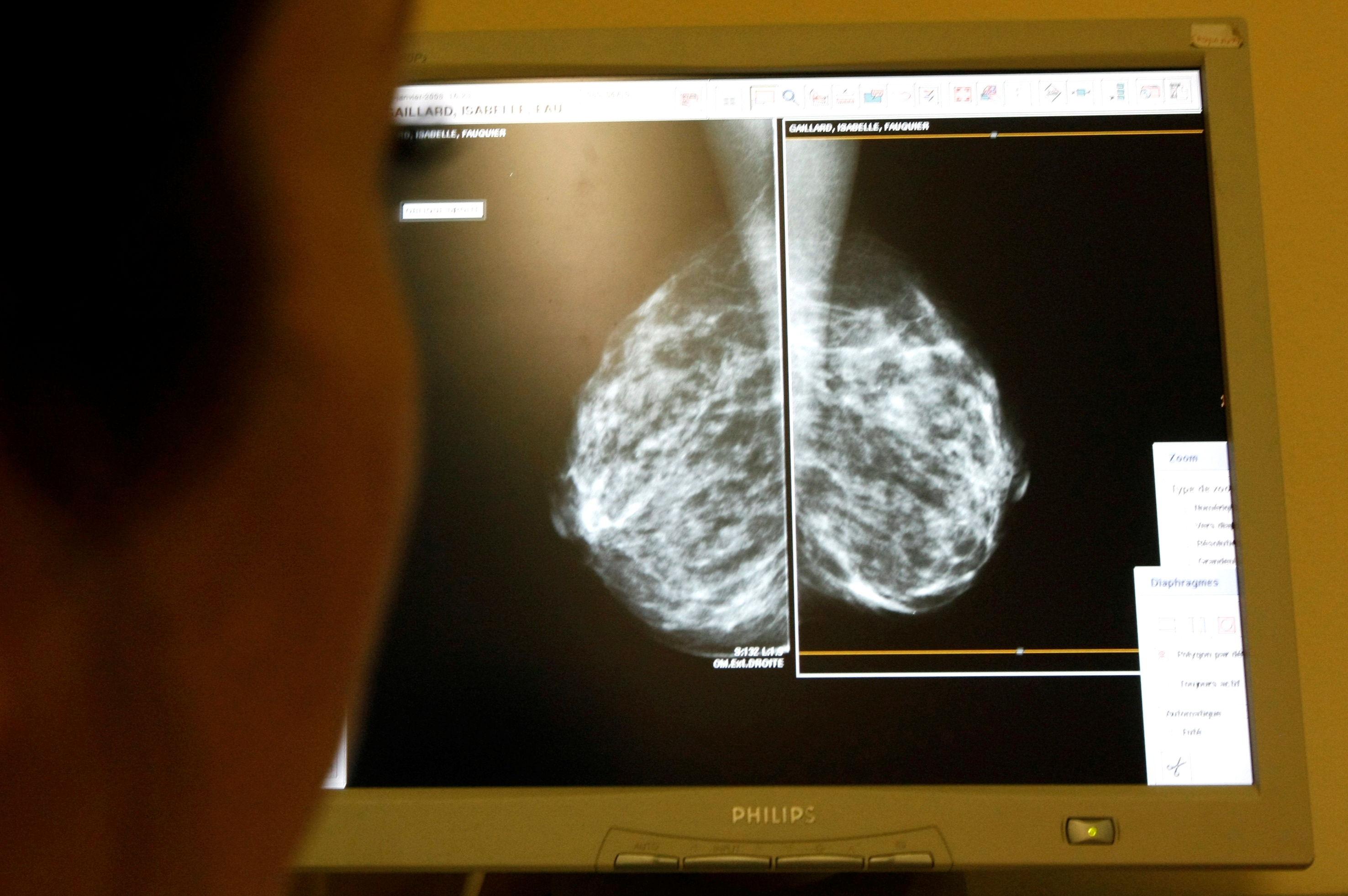 Como en las mujeres, el tratamiento del cáncer de mama en los hombres depende de qué tan grande sea el tumor y cuánto se haya extendido (REUTERS)