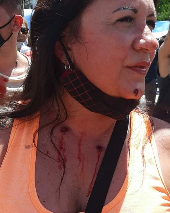 Una mujer recibió balazos de goma en su cuello y el rostro