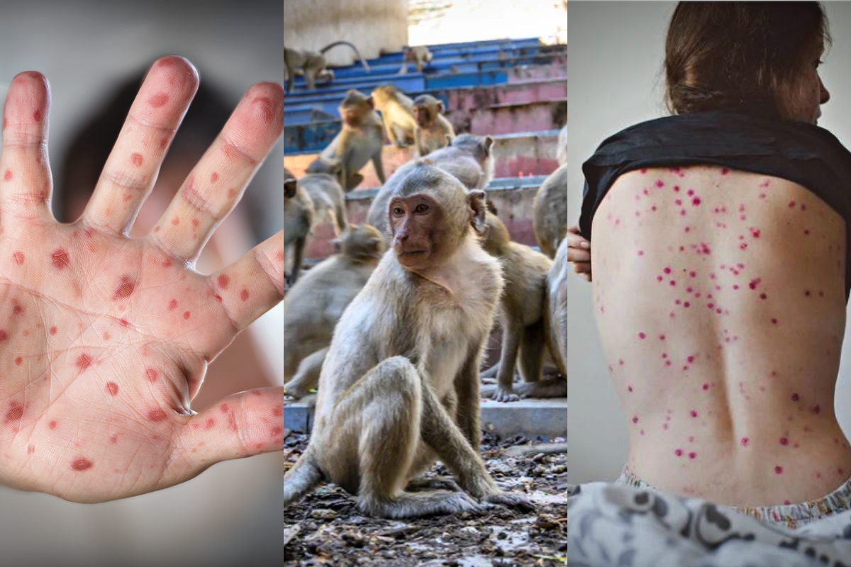 Viruela del mono: Bélgica se transformó en el primer país en ordenar la cuarentena obligatoria para los infectados