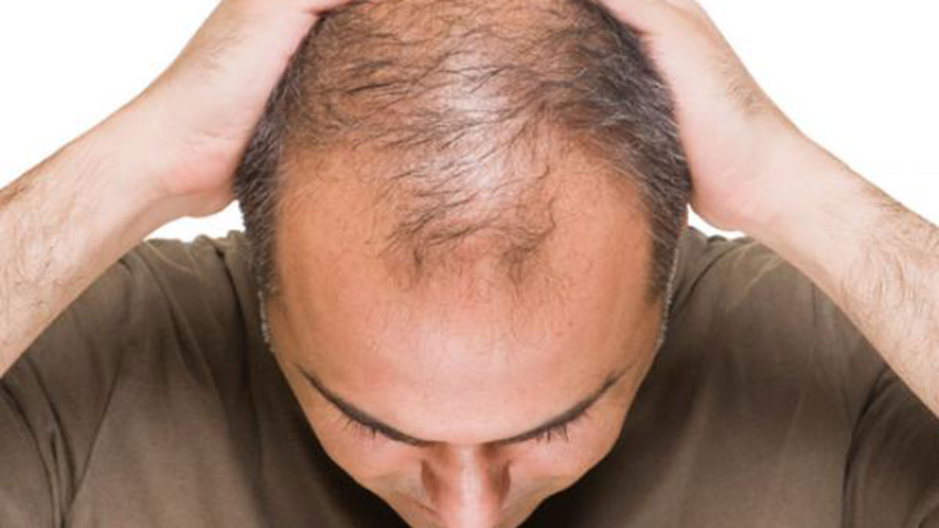 Las alopecias, es decir, falta de cabello, se pueden dividir en dos grandes grupos: las alopecias cicatrizales y las que no lo son, las más frecuentes