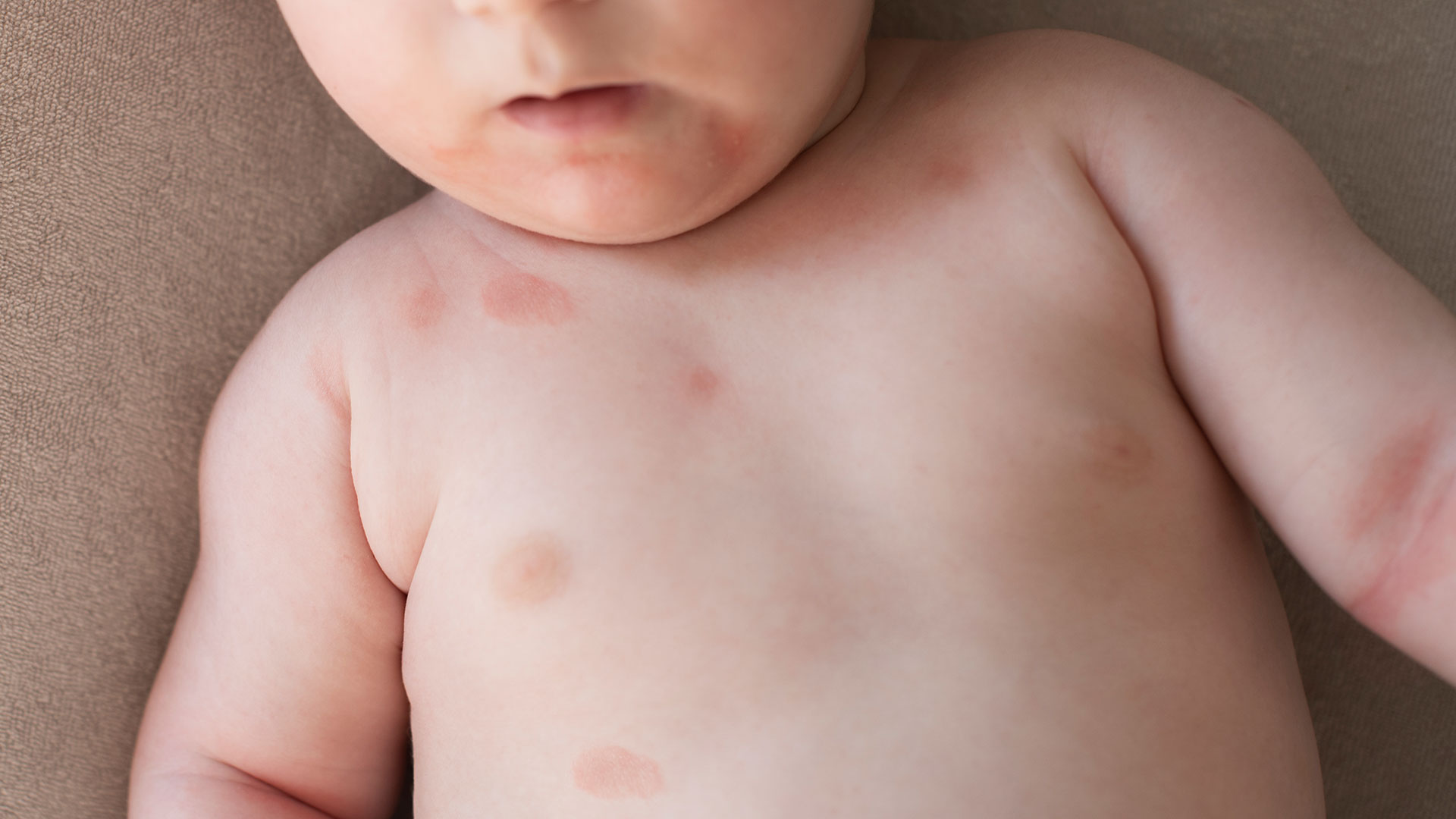 Se estima que la dermatitis es la tercera enfermedad de prevalencia en la infancia y que su incidencia se triplicó en los últimos 30 años (Getty)
