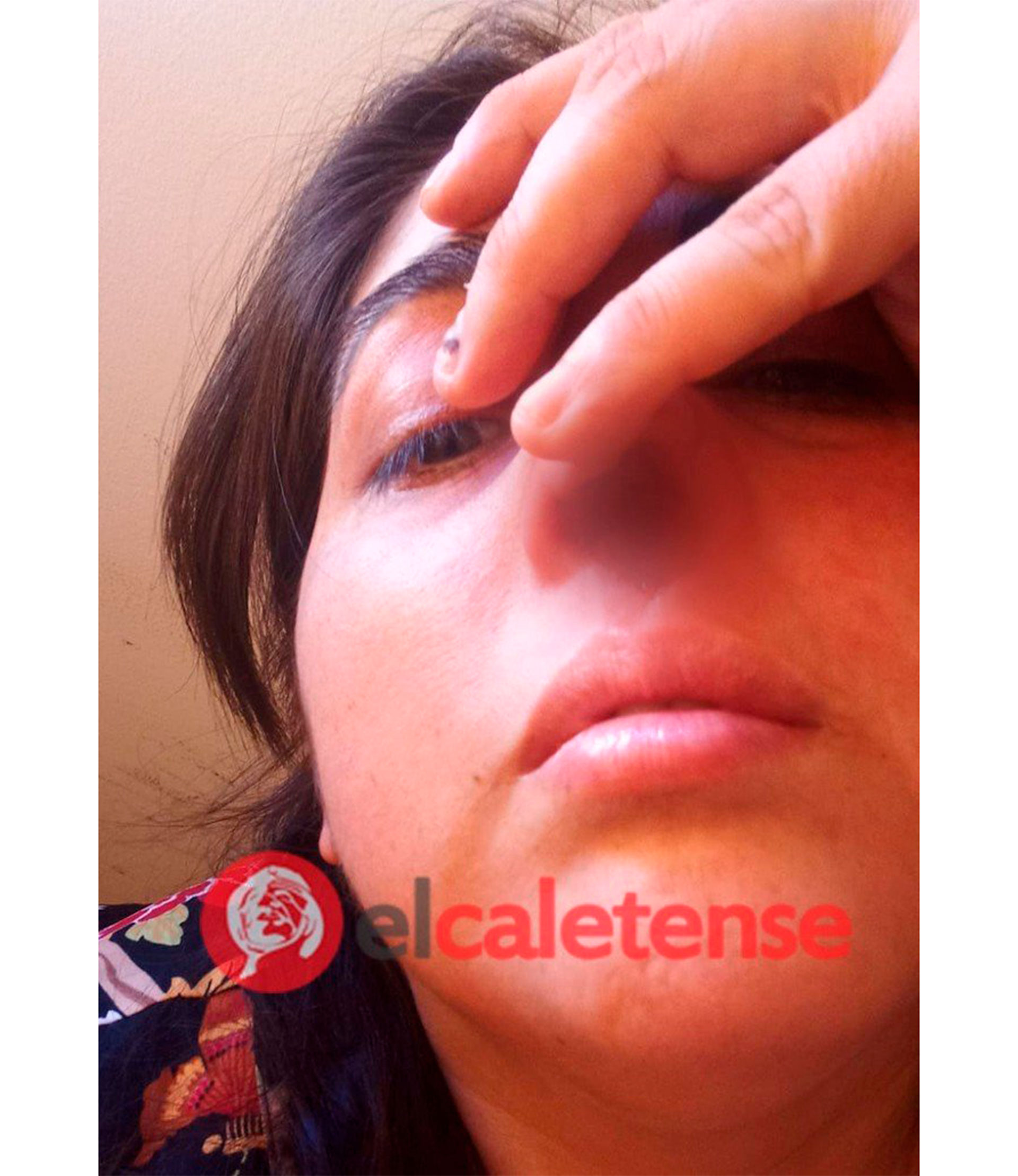 Claudia Serran muestra cómo perdió el cartílago de su nariz luego de un hisopado por COVID-19.
