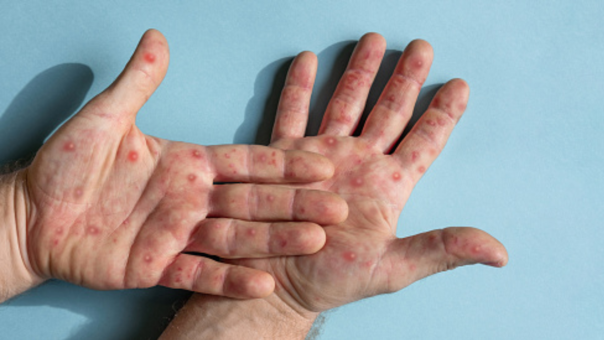 Las lesiones con granos en la piel son los síntomas más frecuentes de la viruela del mono/Archivo