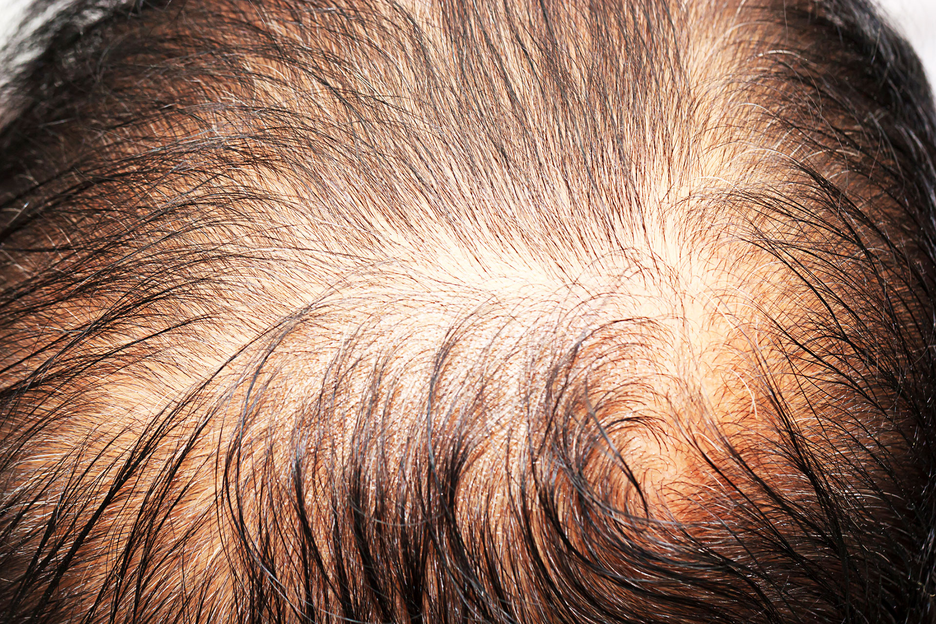 Un caso de alopecia involutiva