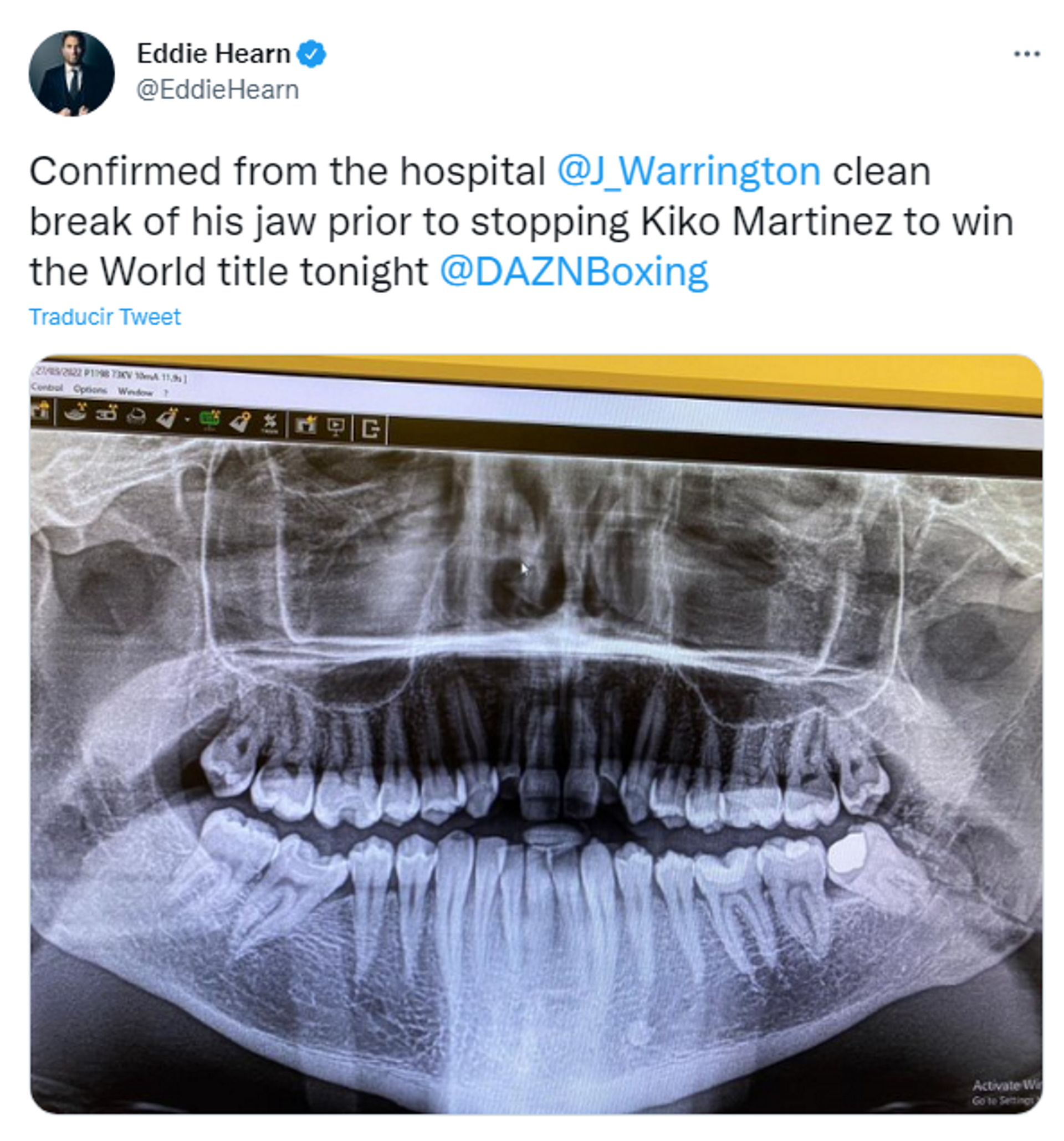 La mandíbula fracturada de Warrington (@EddieHern)