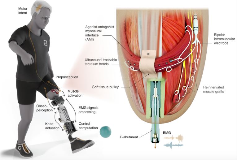 Cómo es la nueva rodilla biónica que permite mejor la movilidad en personas  amputadas - Infobae