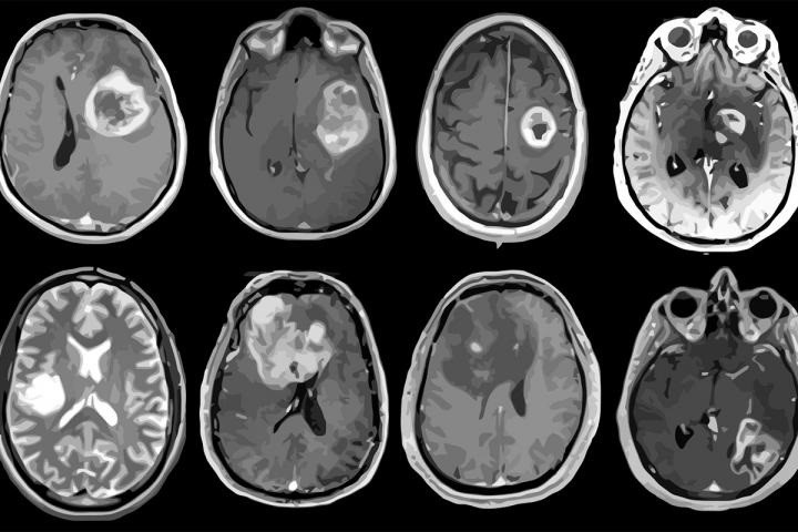 El tratamiento por Captura Neutrónica en boro y la protonterapia son esperanzas para pacientes con cáncer cerebral para el futuro/Archivo
