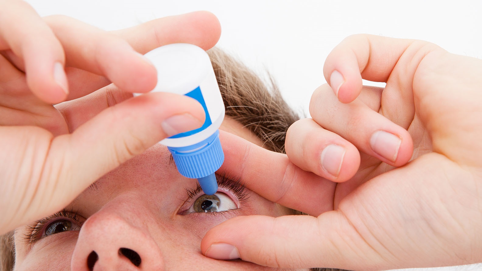 El glaucoma es una neuropatía óptica, multifactorial, progresiva y crónica