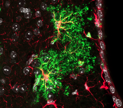 Los científicos buscan conocer el comportamiento de las células del cerebro para adelantarse a la enfermedad 