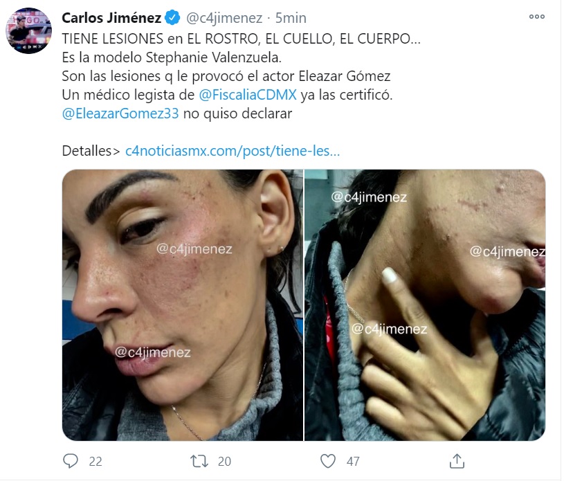 Las imágenes de las lesiones que habría provocado el actor a su novia