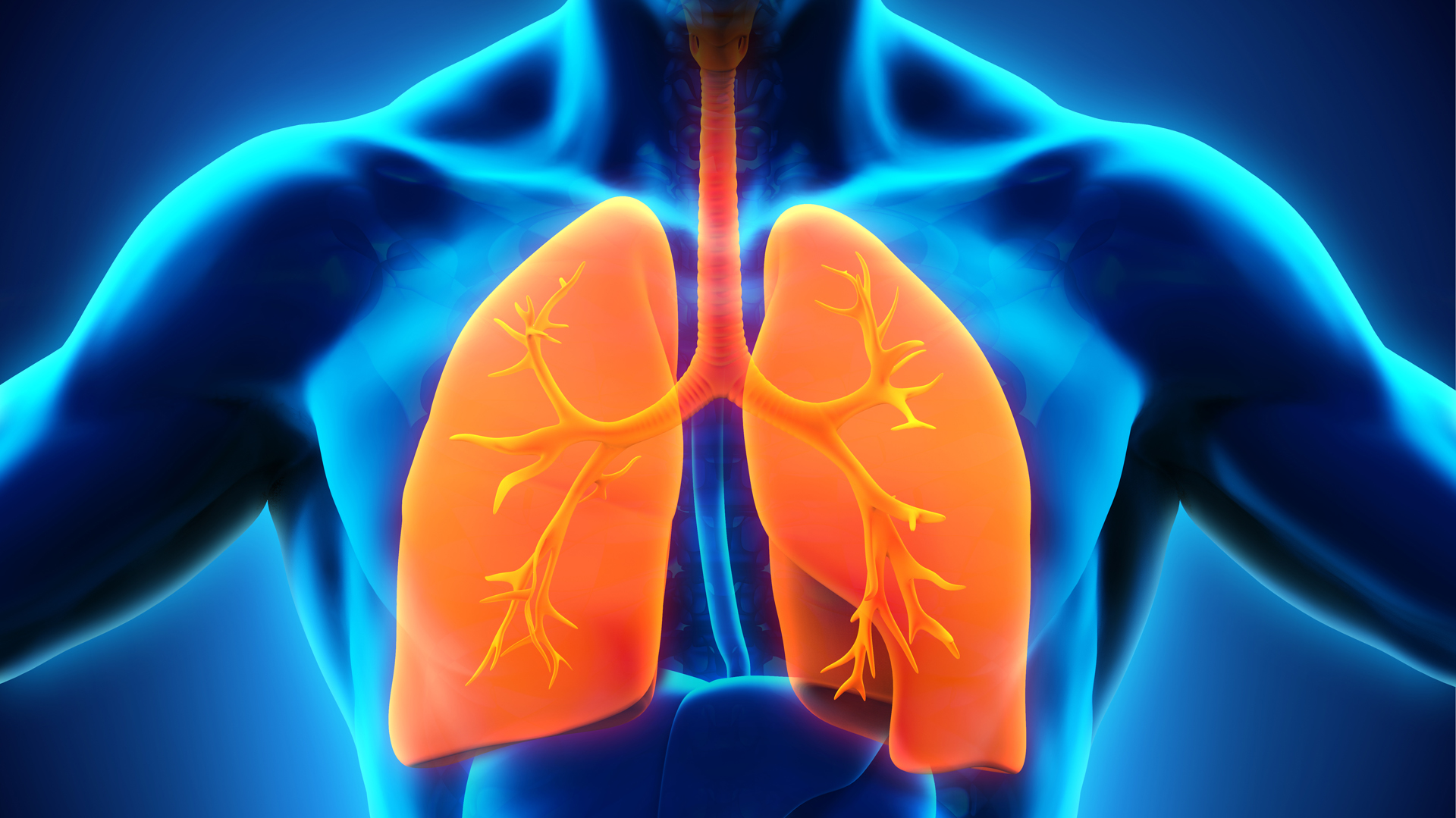 La bronquiolitis es causada por el Virus Sincicial Respiratorio (VSR)