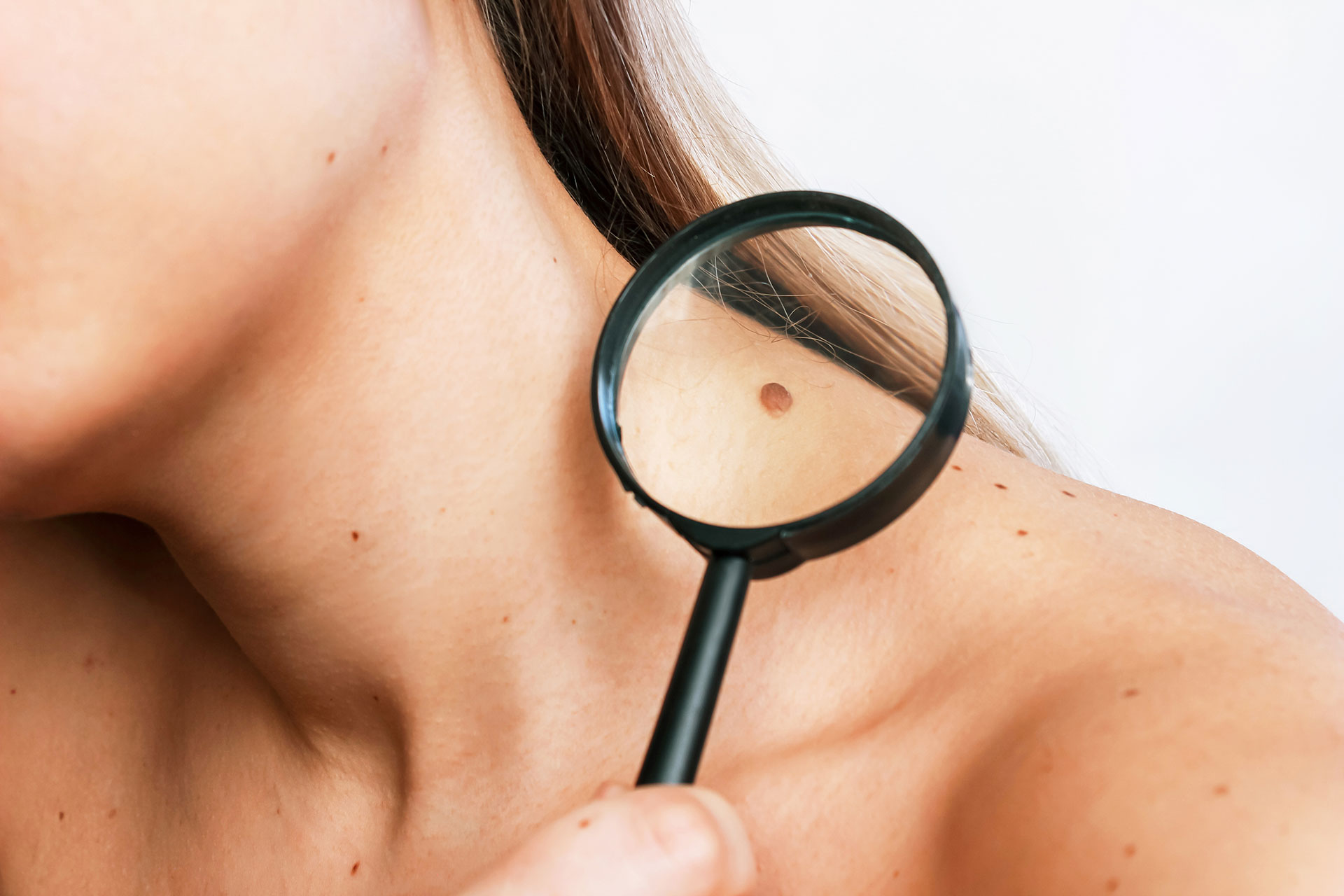 El melanoma es el tipo de cáncer de piel más agresivo (Freepik)