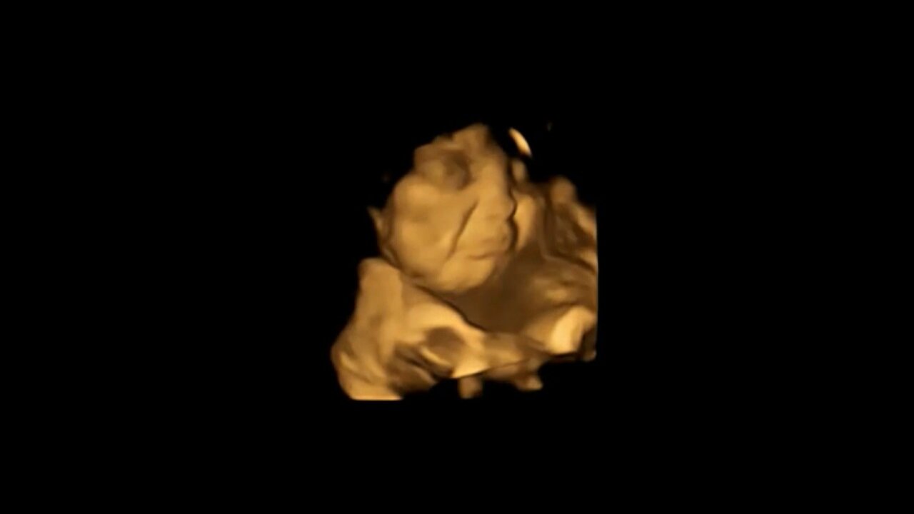 El mismo feto muestra una reacción de cara de llanto después de haber estado expuesto al sabor de la col rizada / Crédito: Estudio FETAP (Preferencias de sabor fetal), Laboratorio de Investigación Fetal y Neonatal, Universidad de Durham