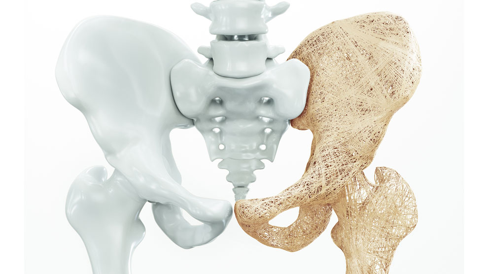 Osteoporosis: la importancia de la detección temprana y los hábitos saludables para minimizar sus riesgos
