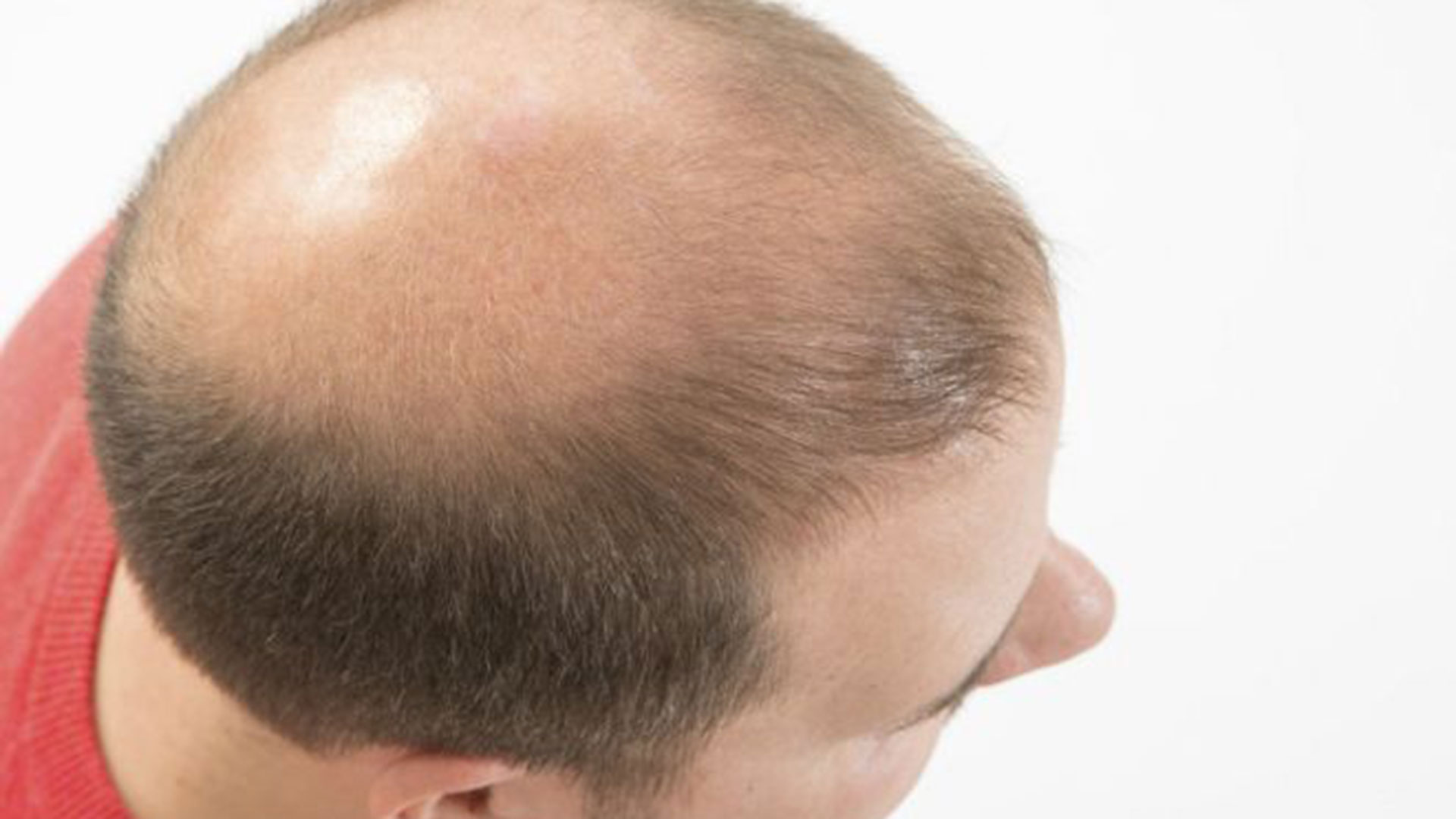 The judges said that suffering from baldness can be emotionally devastating for a man so it is not okay to comment on his physical appearance. 