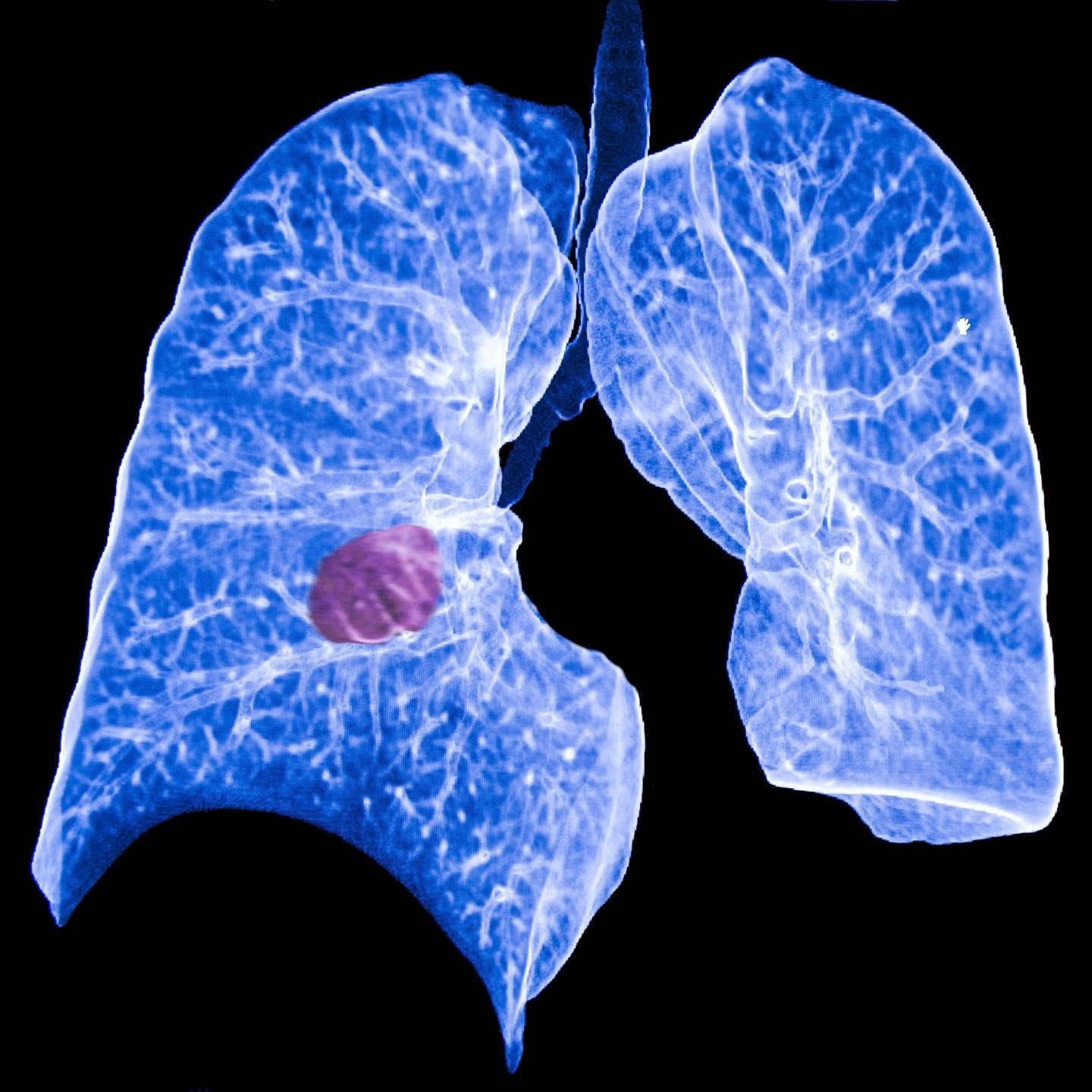 Cáncer de pulmón (ESPAÑA EUROPA MADRID SALUD ATS)
