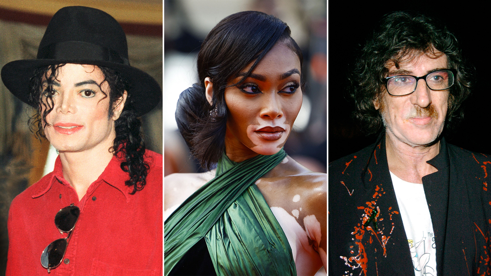 Desde el mundo de la música hasta las pasarelas: quiénes son los famosos con vitiligo