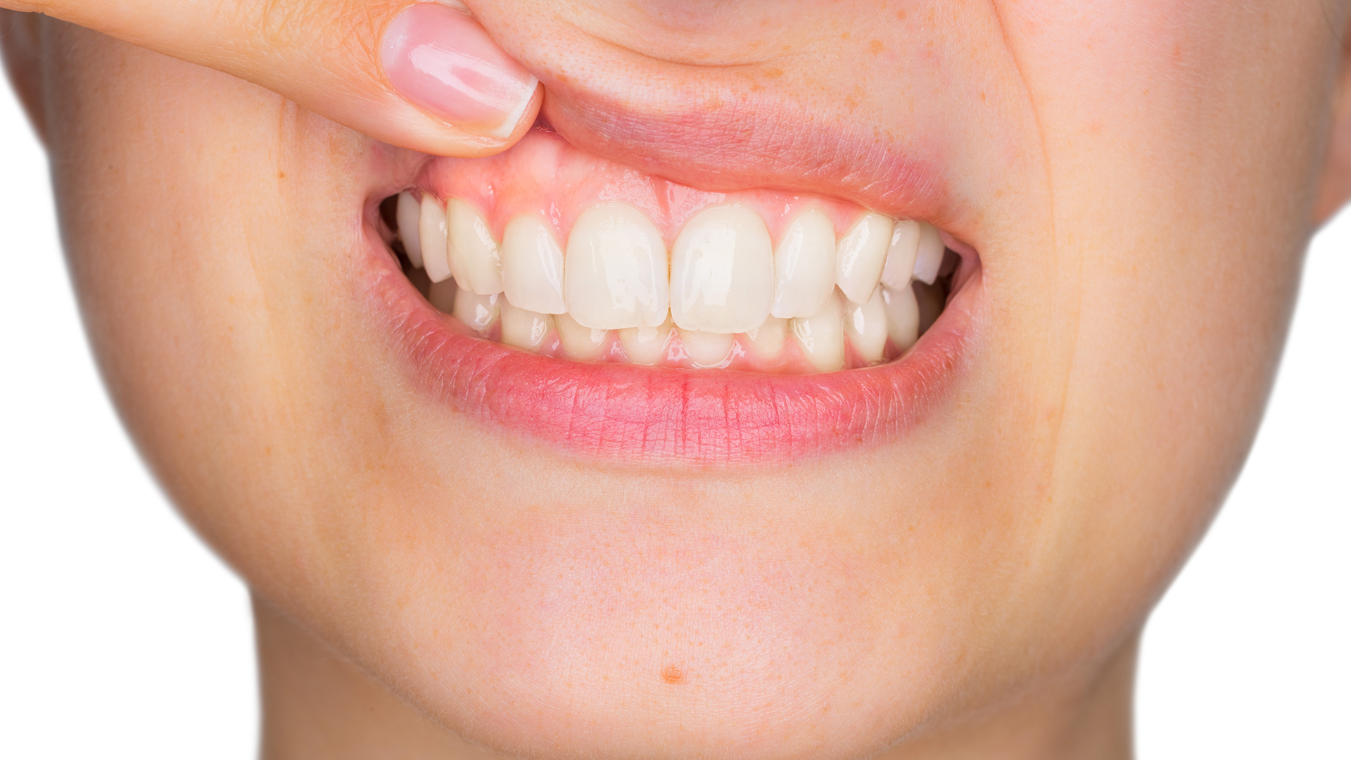 Si no se trata, la gingivitis puede convertirse en periodontitis, un tipo más grave de la enfermedad en el que las encías se retraen, pierdes hueso y los dientes pueden aflojarse o incluso caerse. (Shutterstock) 