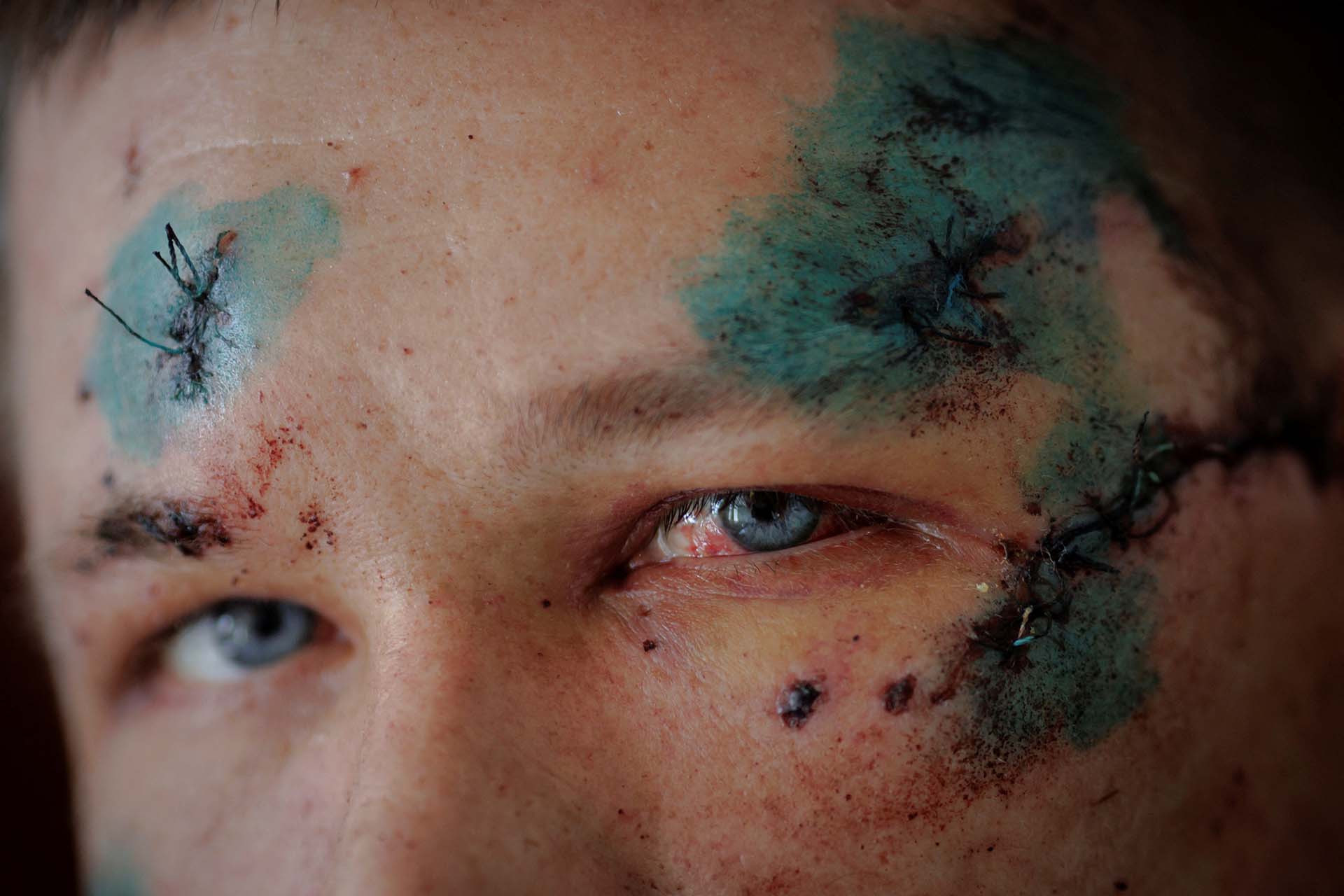 IMÁGENES SENSIBLES. Sergiy, quien fue herido en la cabeza y perdió varios dedos durante un bombardeo ruso contra su aldea, descansa en un hospital Chuhuiv, en las afueras de Kharkiv (REUTERS/Thomas Peter)