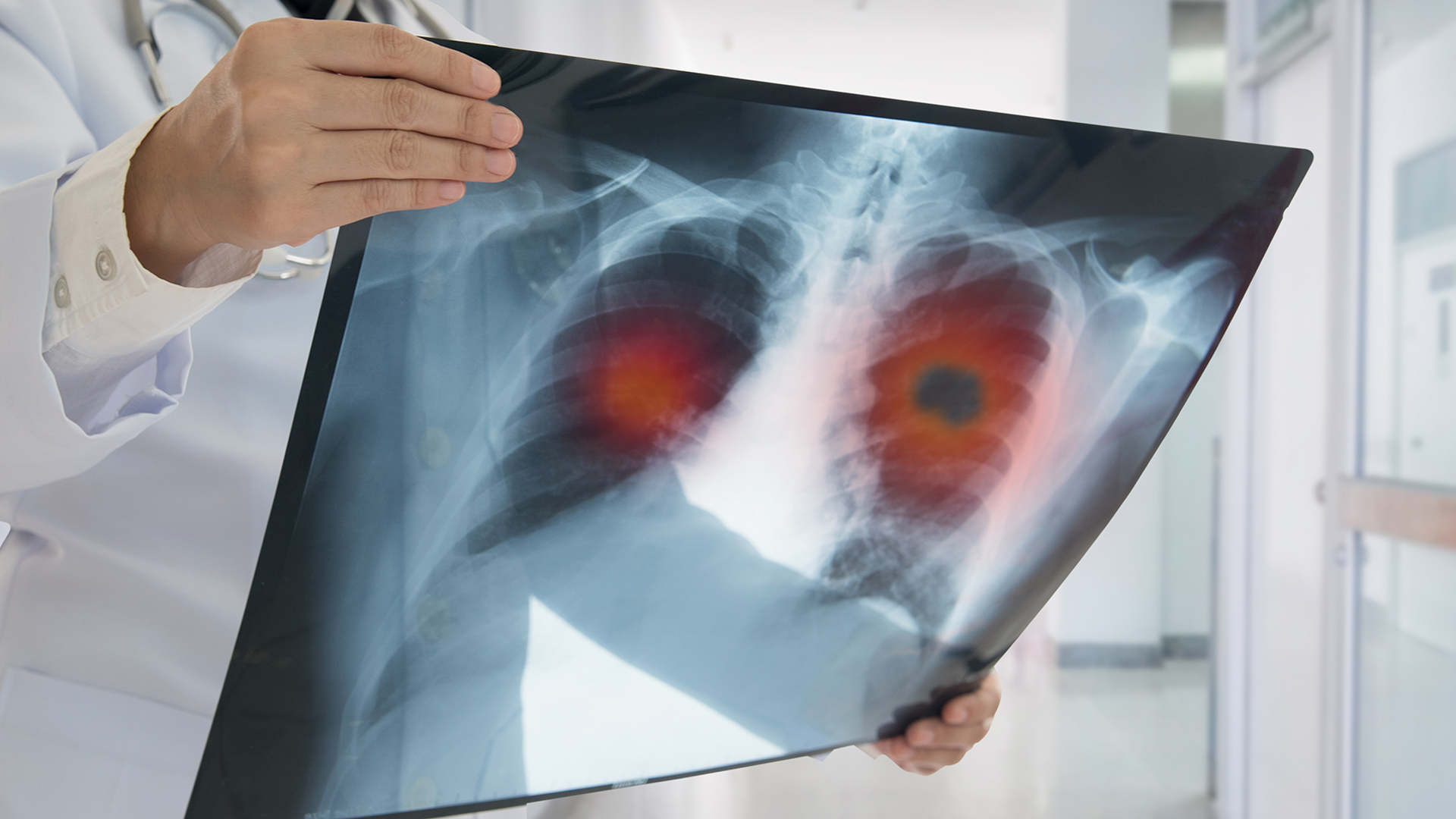 El cáncer de pulmón es una enfermedad maligna que puede localizarse en el tejido pulmonar propiamente dicho, en el interior de los bronquios, o en ambos sitios (Getty)