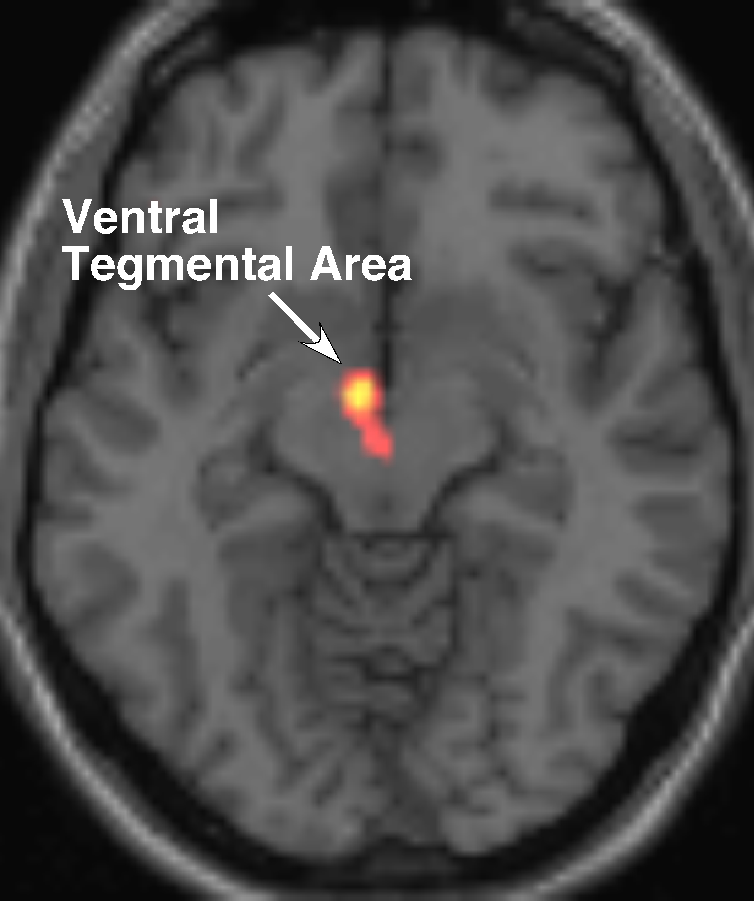 El área tegmental ventral genera dopamina y la manda a distintas regiones del cerebro