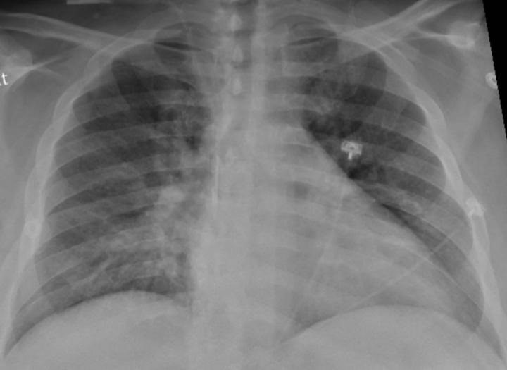 La radiografía de tórax de un paciente positivo de COVID-19 que muestra una neumonía en la parte inferior de los pulmones.
SALUD
RADIOLOGICAL SOCIETY OF NORTH AMERICA
