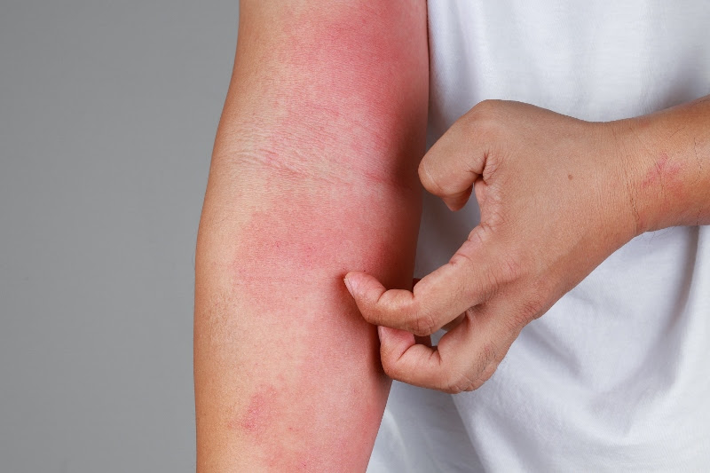 Sentir picazón o inflamación puede ser señal de dermatitis atópica, en algunos casos. Es fundamental consultar a un profesional ante cualquier sospecha