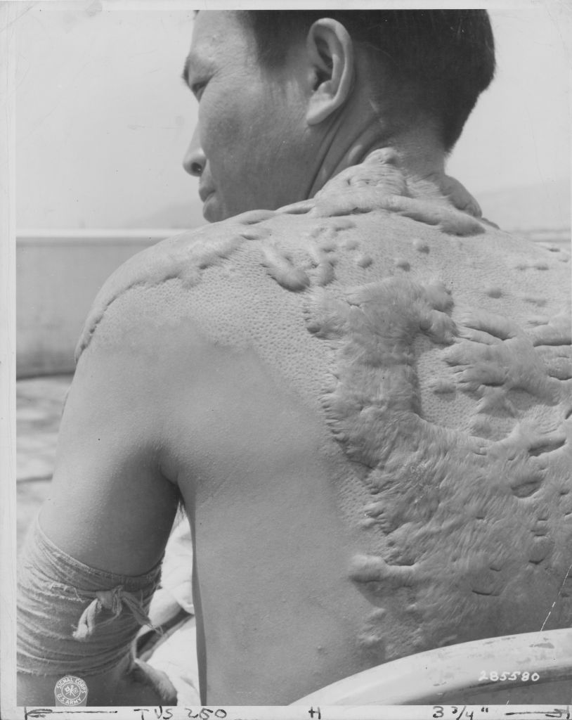Una víctima japonesa de la bomba sobre Hiroshima: su cuerpo quedó cubierto de cicatrices queloides de la brutal quemadura cuando el aire se incendió (US Army Signal Corps/FPG/Getty Images)
