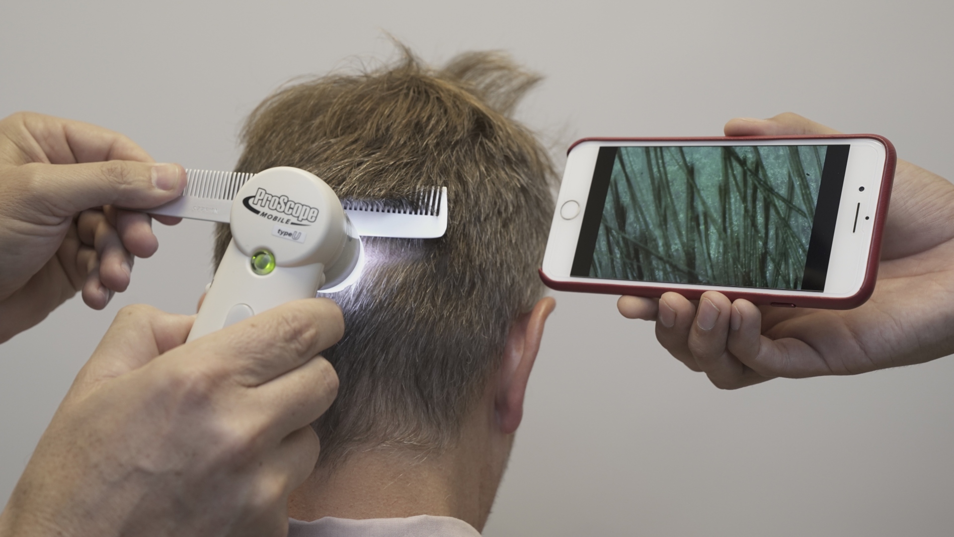 El análisis y diagnóstico de cada paciente resulta fundamental para detectar la causa de la caída del cabello                   