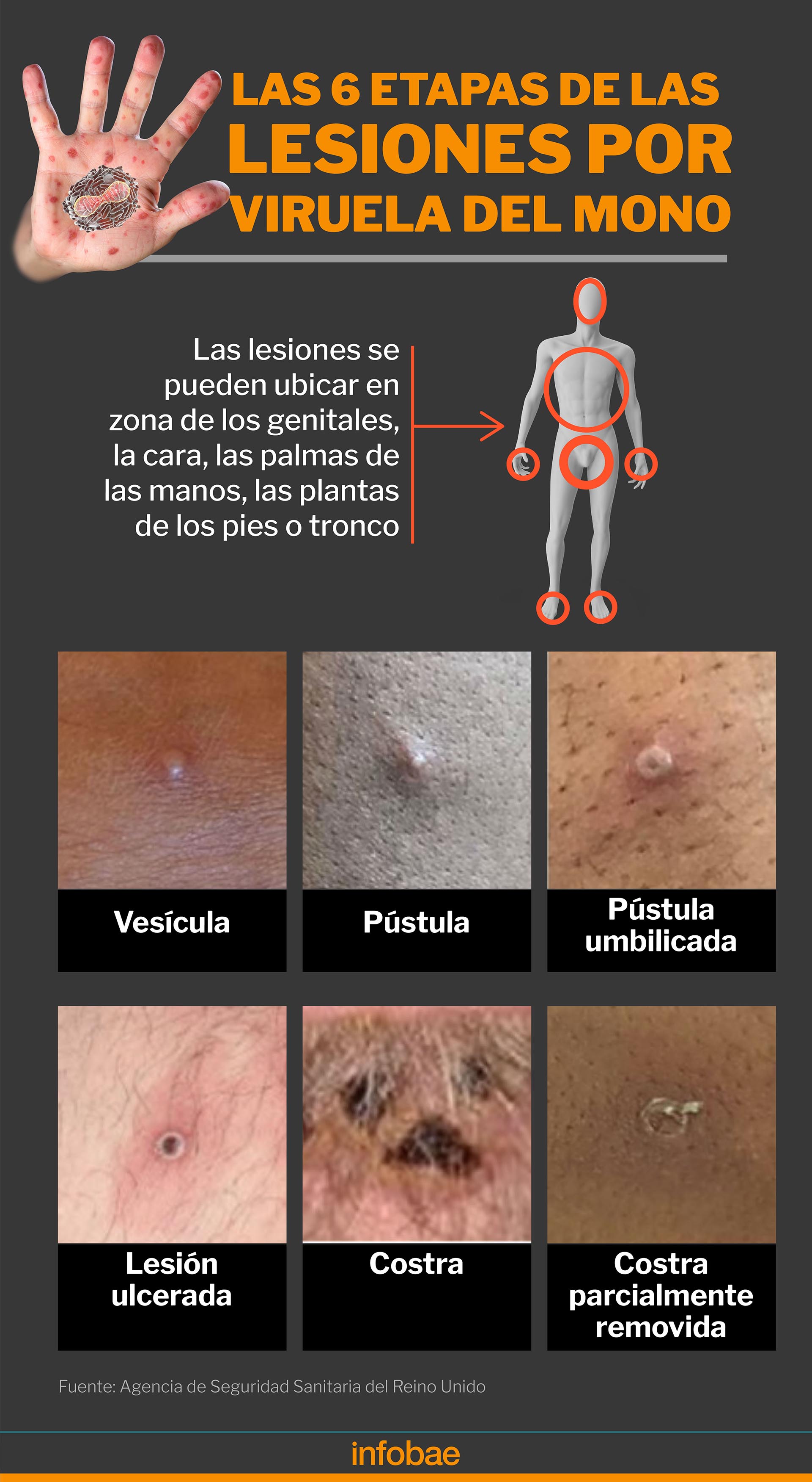 Las etapas de las lesiones en la piel (infografía Marcelo Regalado)