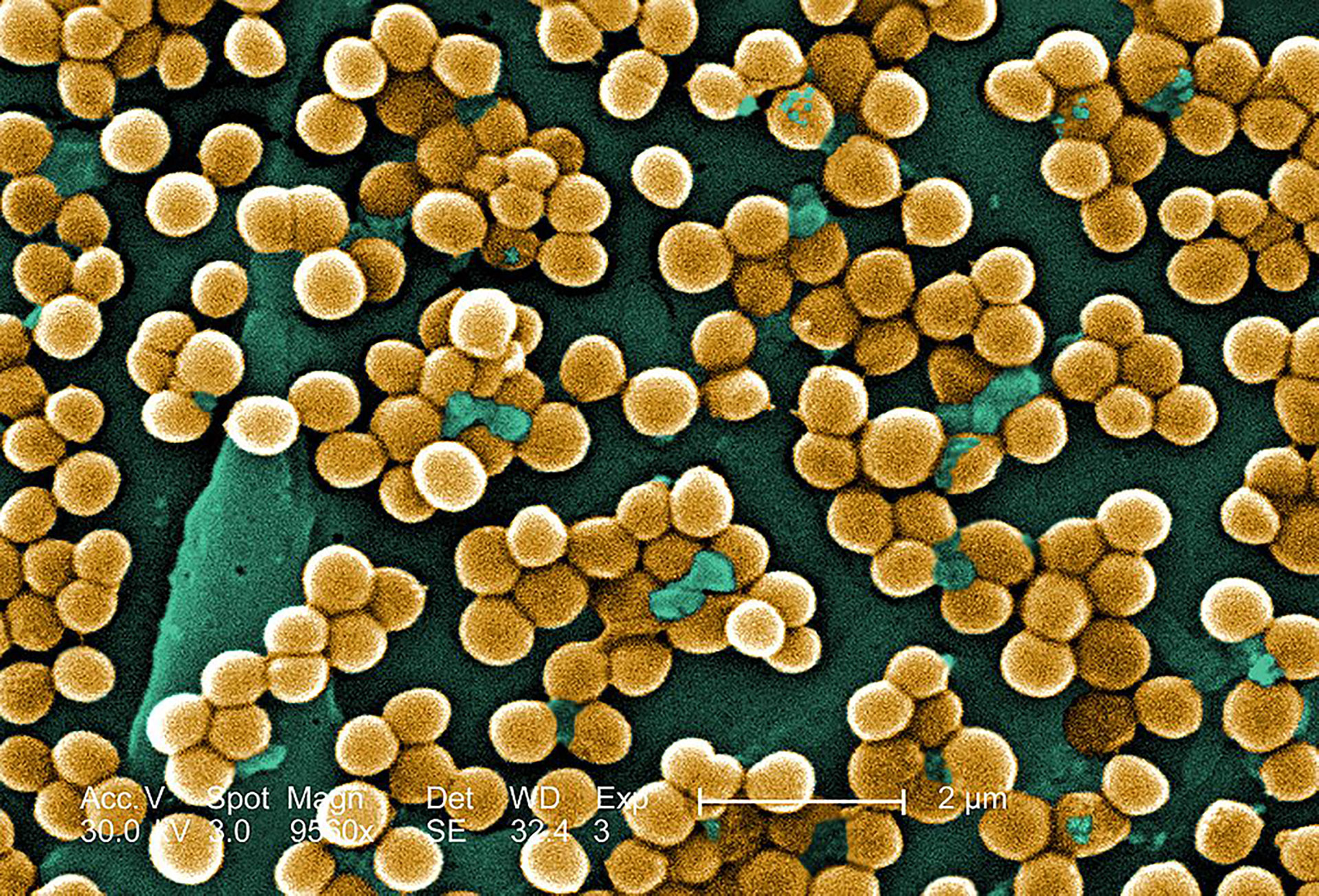 La bacteria Stafilococco aureus meticilino suele provocar neumonías adquiridas en ámbitos hospitalarios