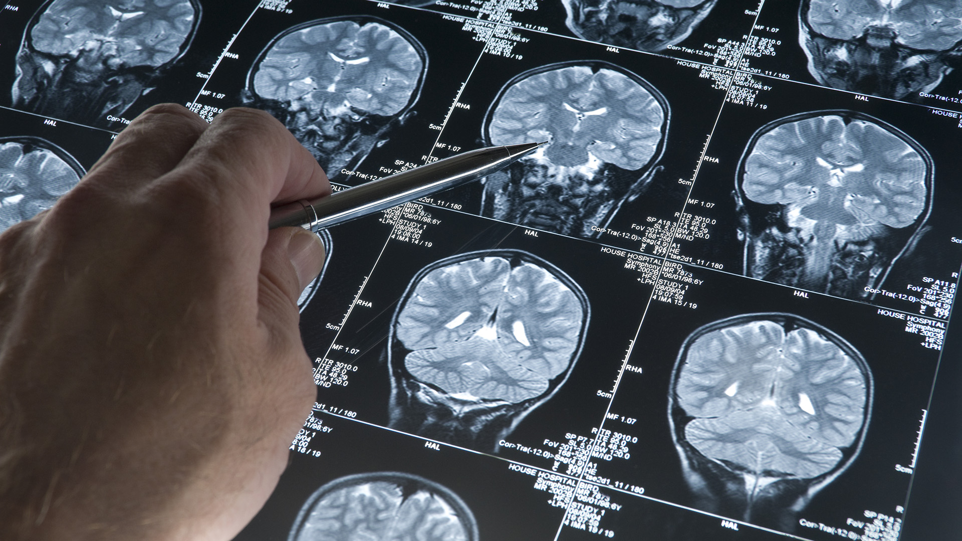 Los primeros cambios en el cerebro ocurren mucho tiempo antes de los primeros síntomas de Alzheimer (Getty)