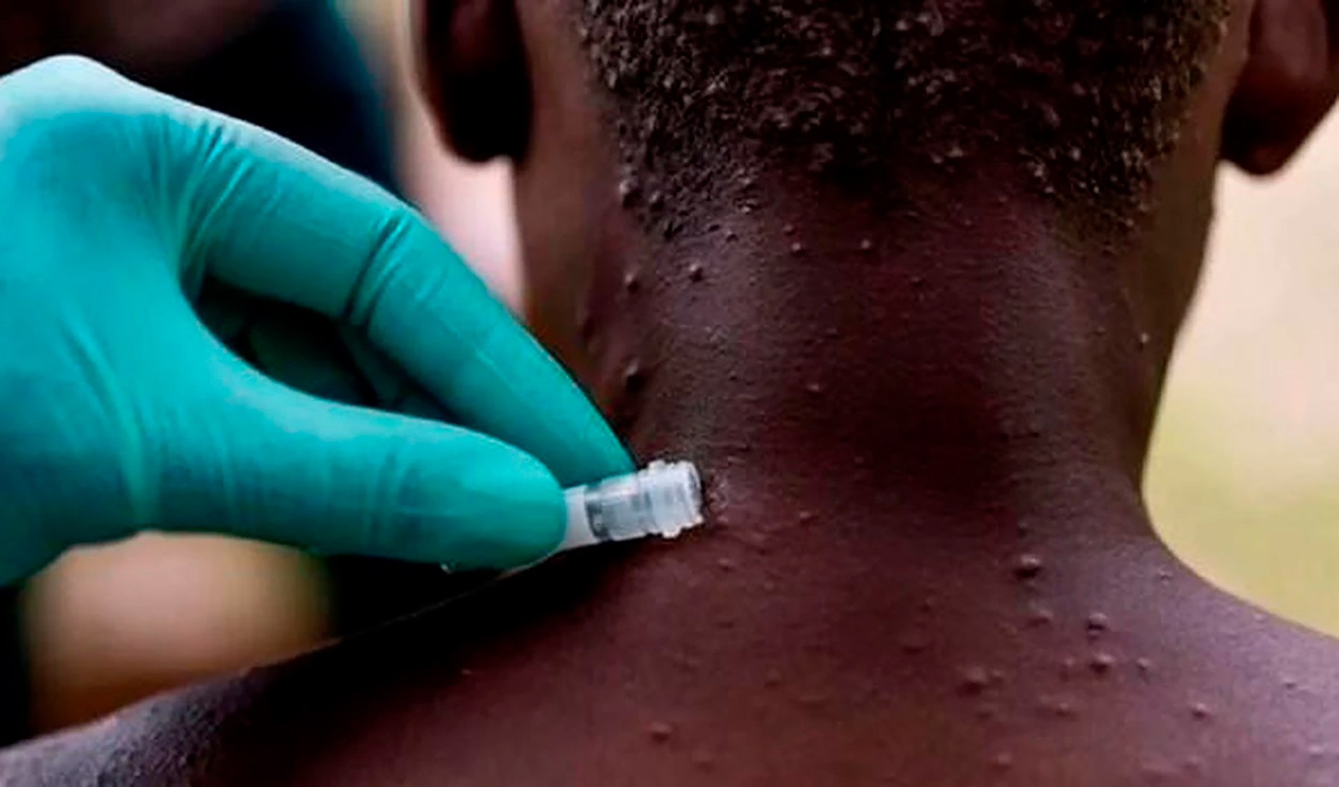 El virus de la viruela símica cuenta con más de 50 años bajo el radar de los especialistas, tanto en su estudio como en el análisis de su comportamiento durante la infección
(Nigeria Centre for Disease Control)