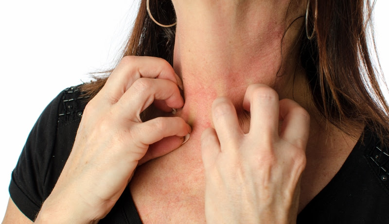 La Dermatitis Atópica es enfermedad crónica y multifactorial de la piel, cuyo principal síntoma es la picazón permanente / 