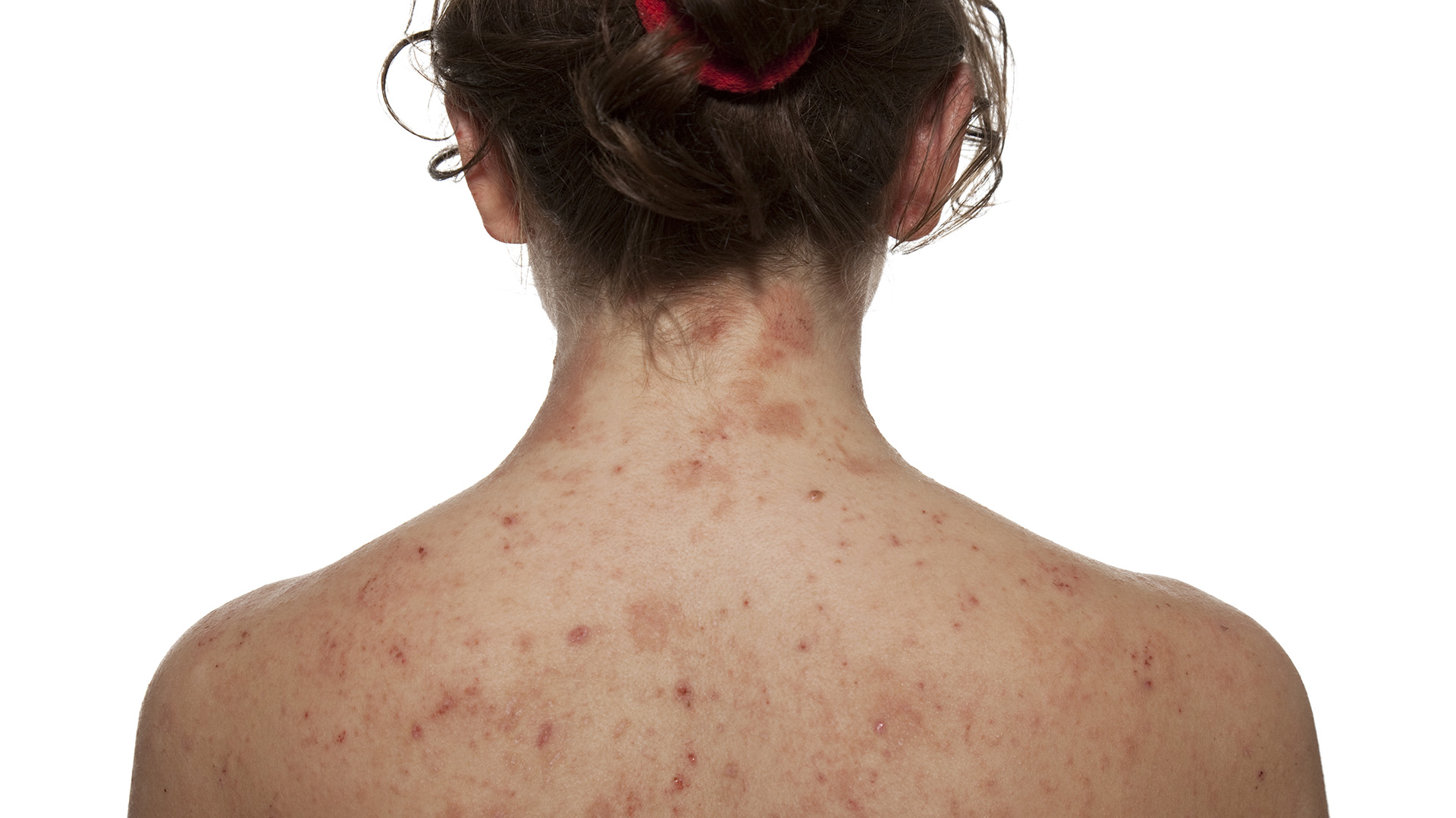 La dermatitis atópica es una condición crónica y recurrente que provoca enrojecimiento, picazón e inflamación de la piel / (Getty Images) / 