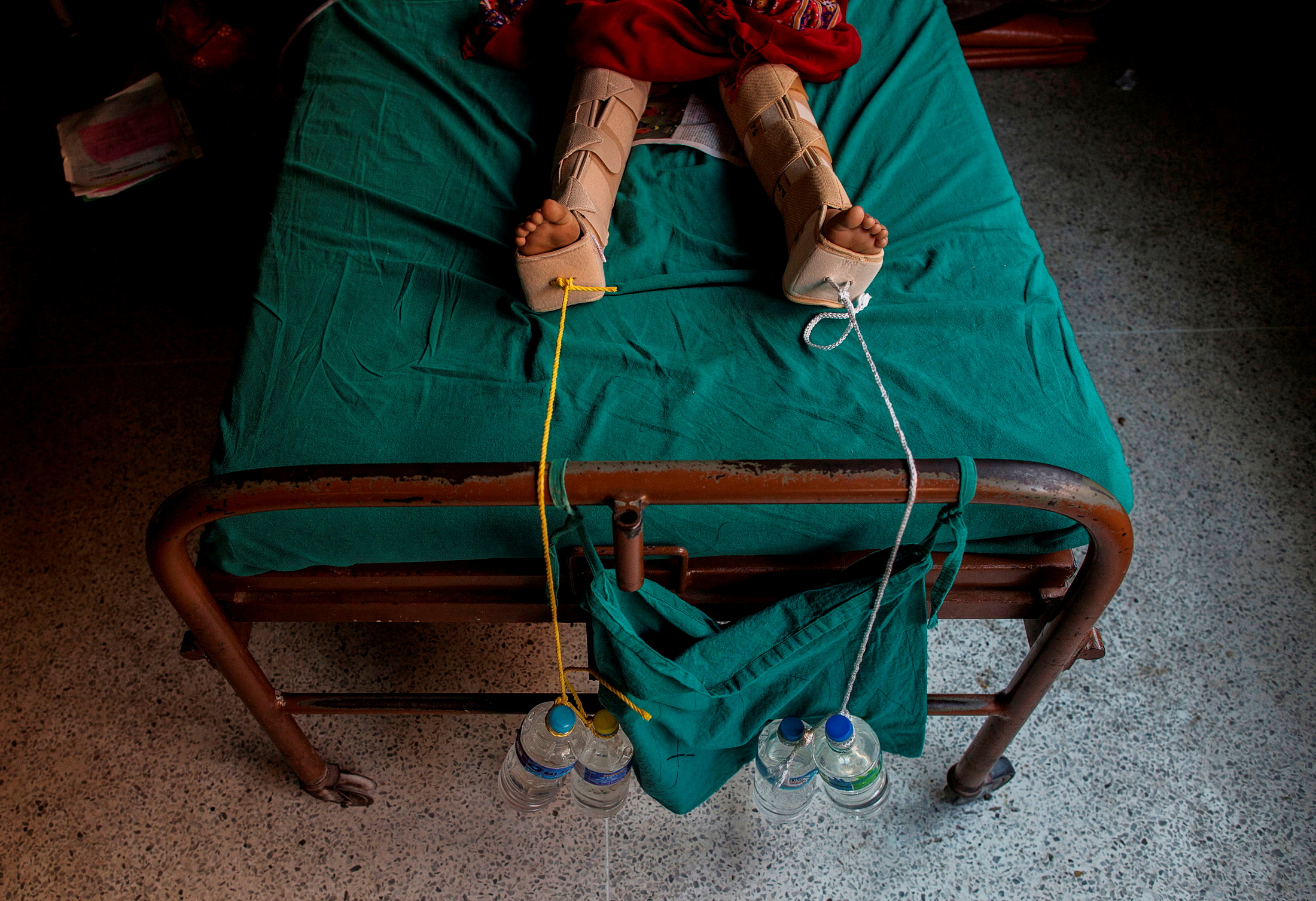 Cuerdas lastradas con botellas de agua se utilizan para aplicar tracción a las piernas de una niña herida tras fracturarse durante un terremoto en un hospital de Katmandú, Nepal, 29 de abril de 2015.