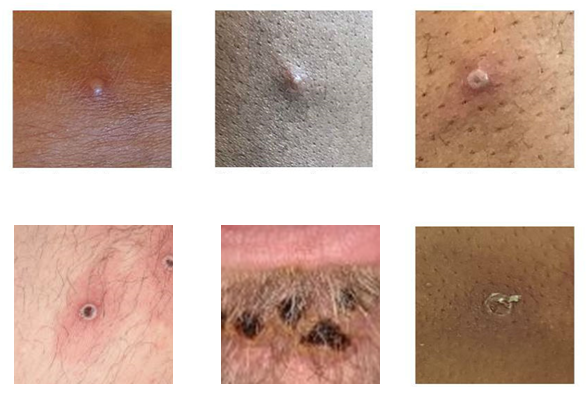 Imágenes de laceraciones en la piel causadas por la viruela del mono
