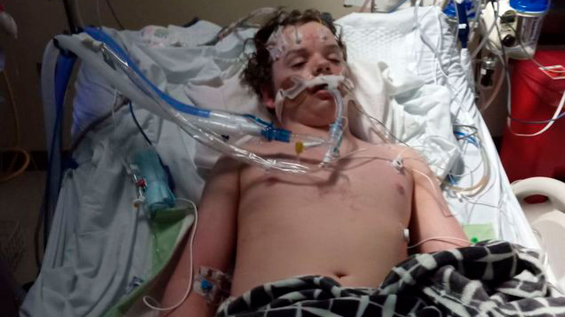 El adolescente Jacob Stevens, hospitalizado y conectado a un respirador artificial tras participar en un challenge de TikTok. (Facebook / Justin Stevens)