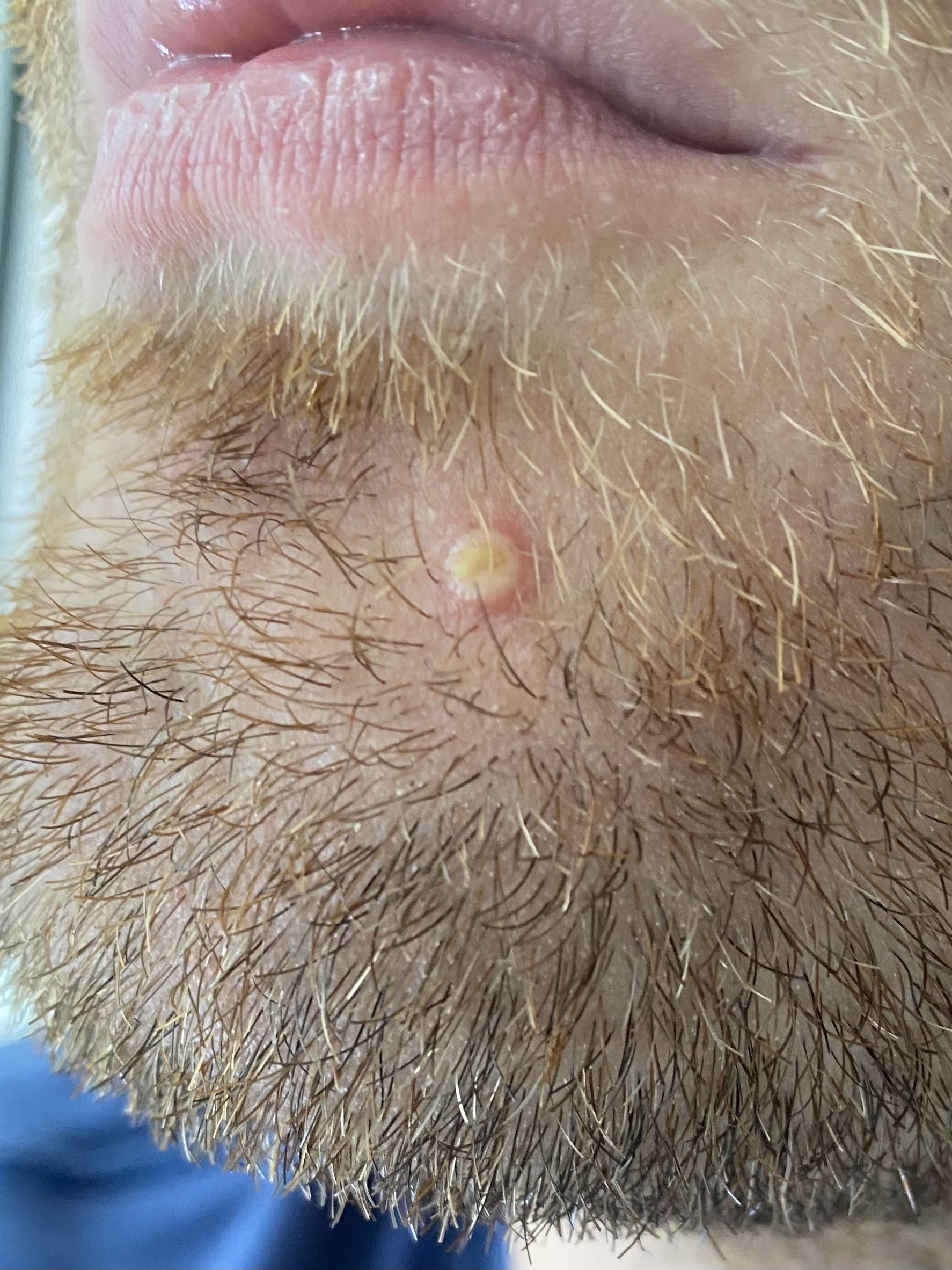 Una de las lesiones de la viruela en la cara de Matt Ford (foto: Twitter @JMatthiasFord)
