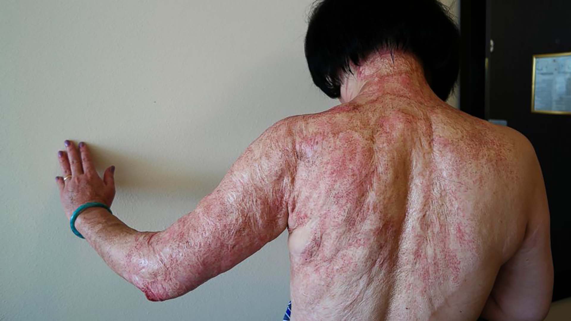 En esta foto del 27 de septiembre de 2015, Kim Phuc muestra las cicatrices de quemaduras en la espalda y los brazos causados ​​por una bomba de napalm en Vietnam (Nick Ut/AP Photo)