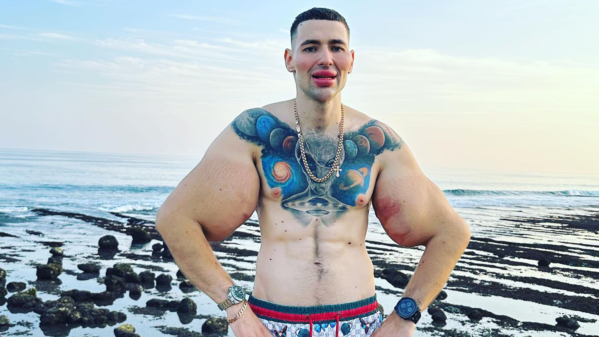 Se inyectó vaselina en los bíceps para hacerlos más grandes y ahora podría perder ambos brazos debido a una infección 