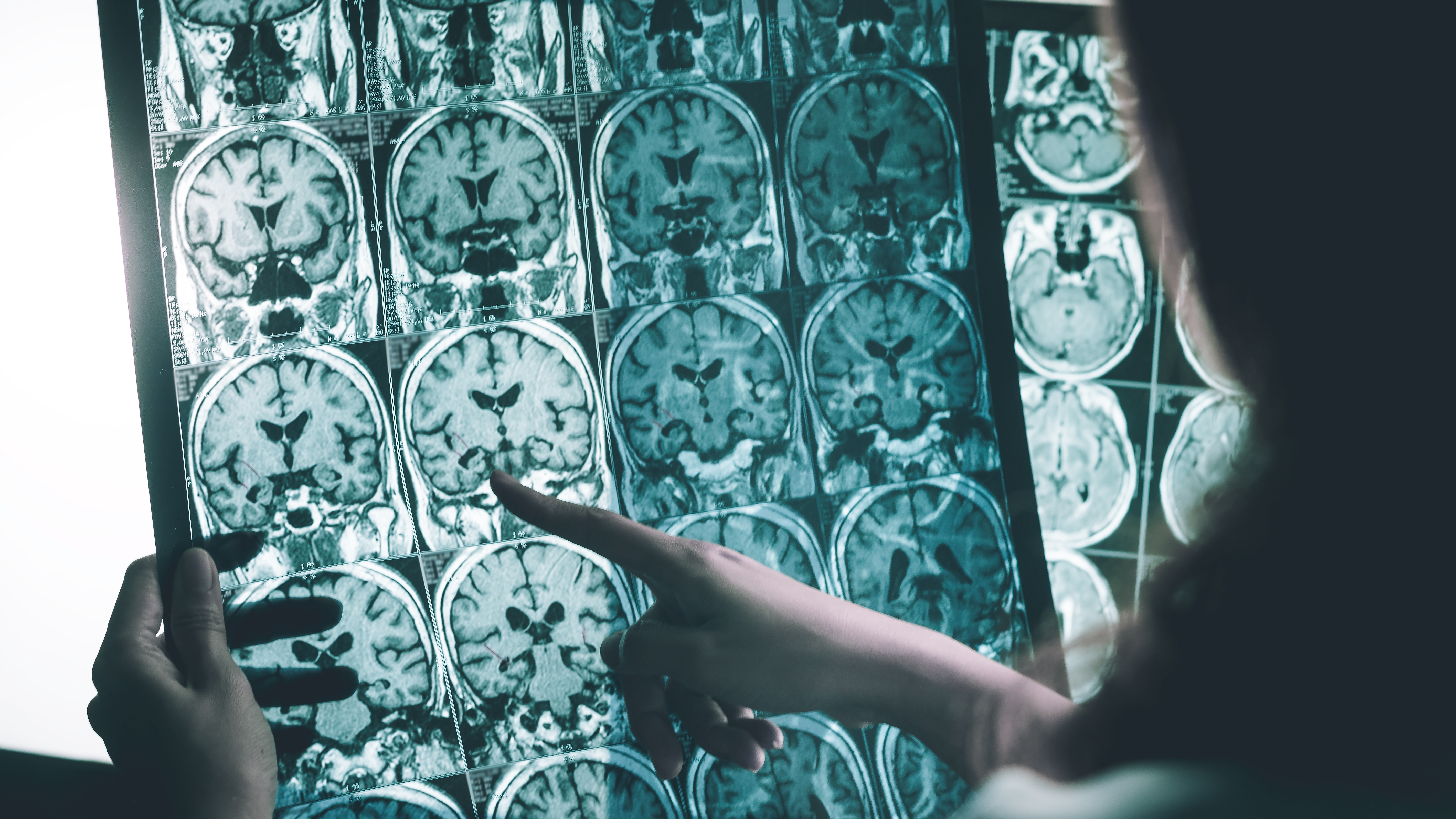 Es una enfermedad progresiva, lo que significa que gradualmente se dañarán mayores partes del cerebro (Shutterstock.com)