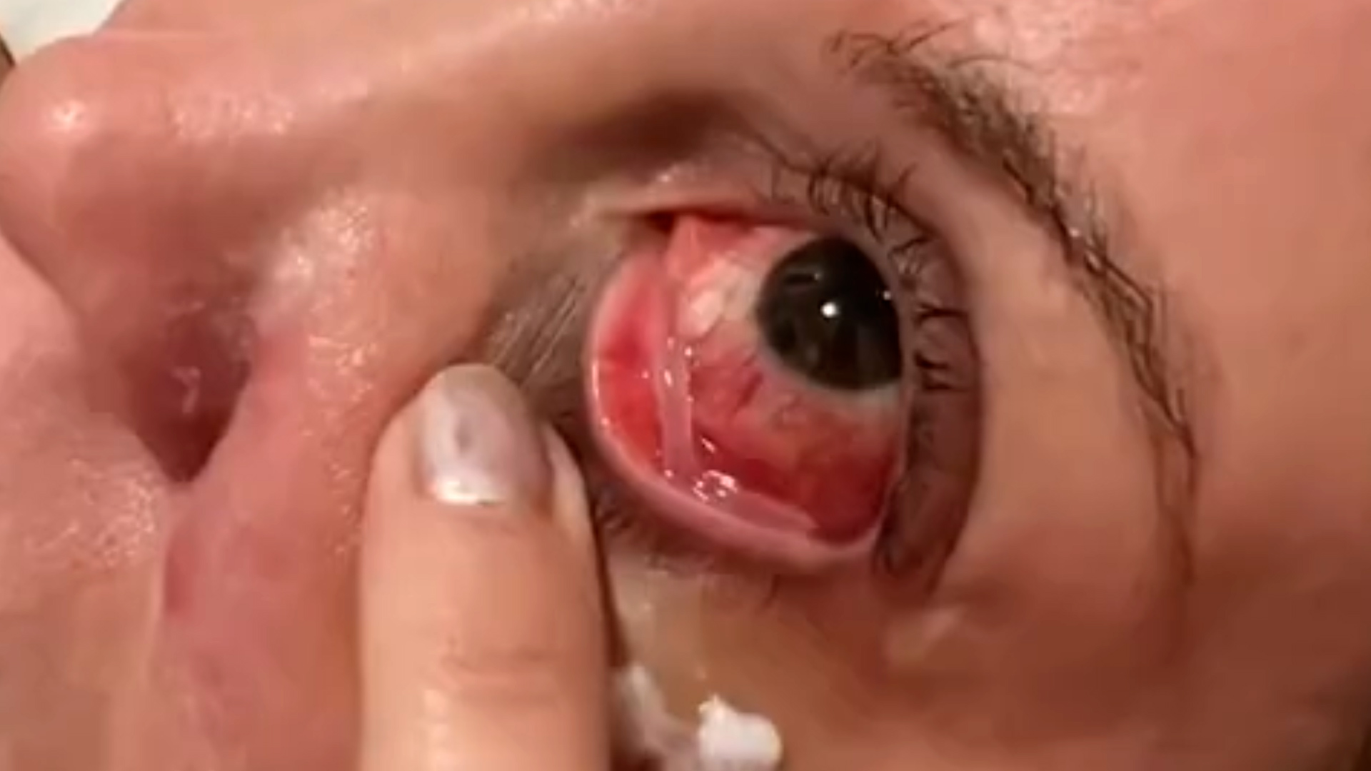 Un detalle sobre la lesión en el ojo que sufrió Miriam Lanzoni tras un ataque de su gato. "Me pasó a un milímetro de la córnea", contó