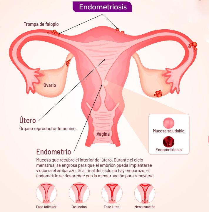 La Organización Mundial de la Salud (OMS) define a la endometriosis como una enfermedad crónica e incurable caracterizada por la presencia de un tejido similar al endometrio (revestimiento del útero) fuera del útero (Foto: DGDC/UNAM)