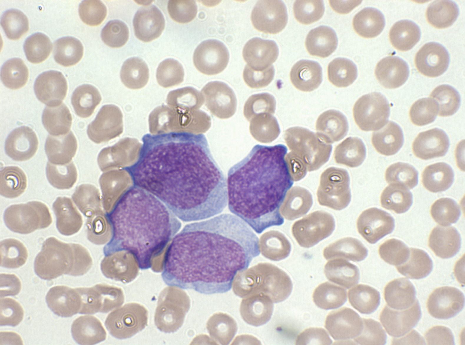 La leucemia suele caracterizarse por la mutación del gen de la nucleofosmina 1 (NPM1) o la reordenación del gen de la leucemia de linaje mixto 1 (KMT2Ar). Para los pacientes que tienen esas alteraciones, se desarrolla un medicamento/Abramson Cancer Center