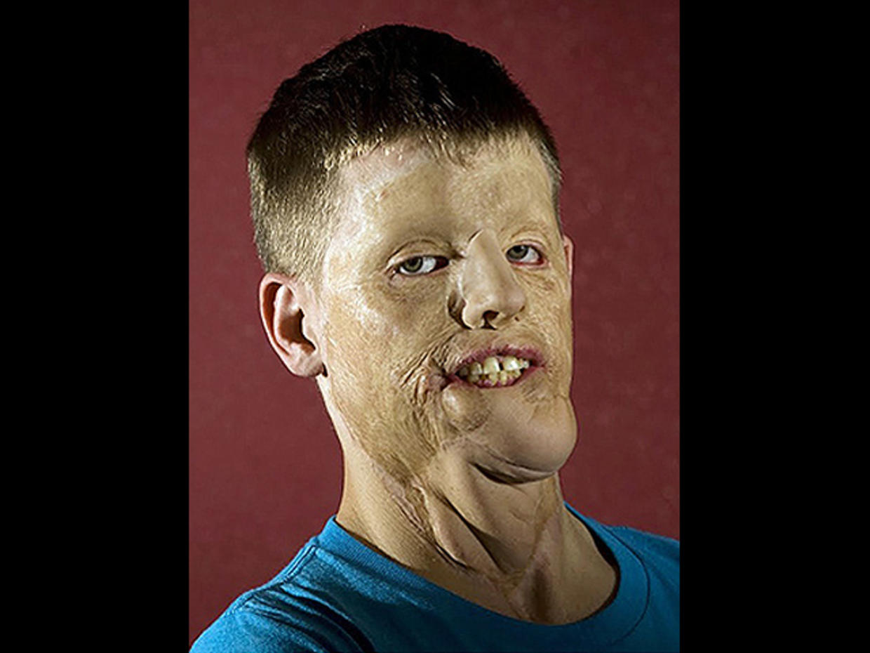 Así lucía Mitch antes de la cirugía y tras haber deformado su rostro en un accidente automovilistico.