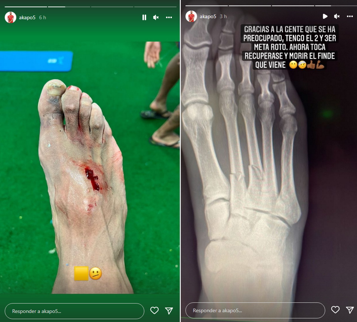 Carlos Akapo mostró cómo le quedó su pie tras el planchazo de Eden Hazard. También compartió la radiografía que confirma la doble fractura (@akapo5)