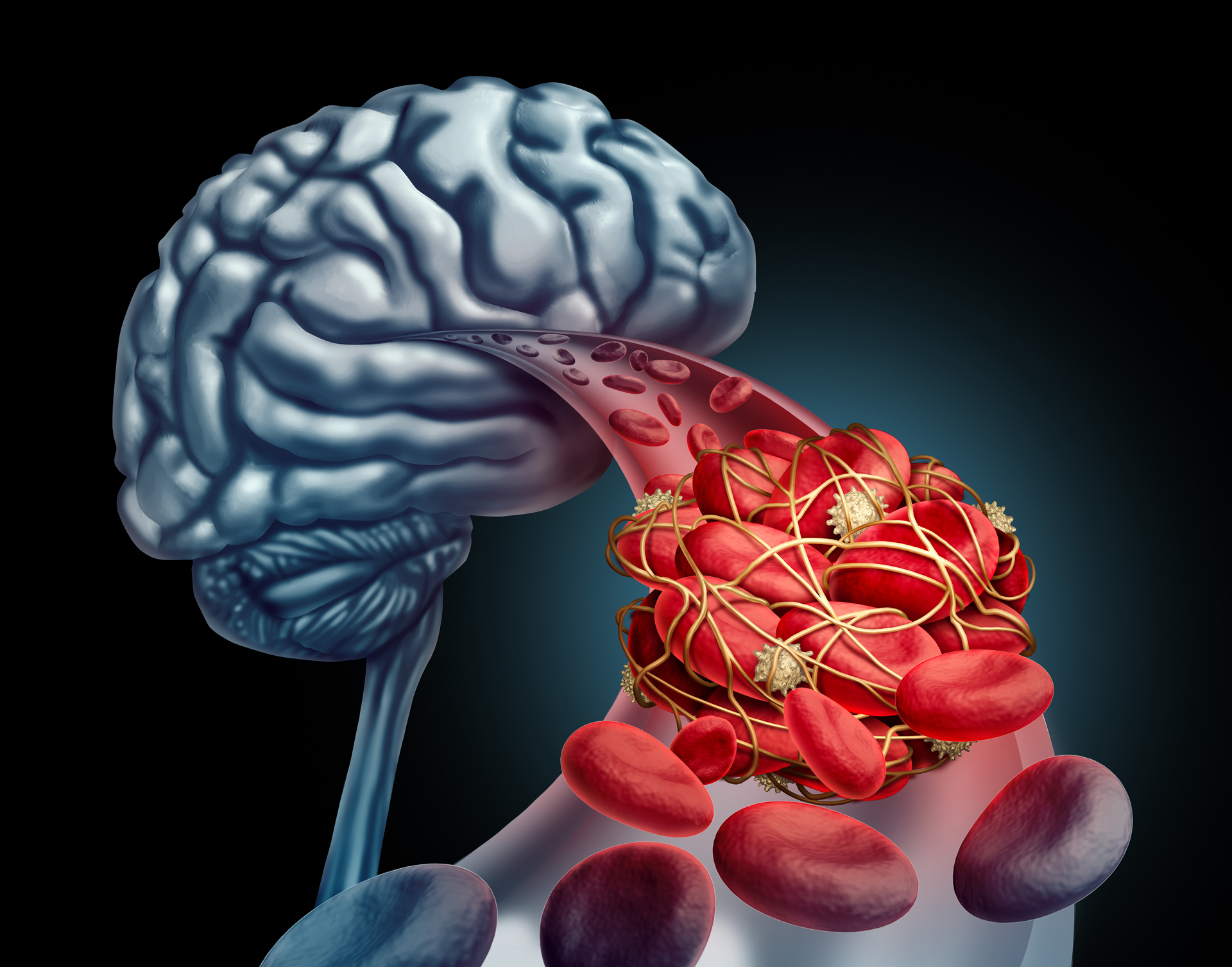Blood clot brain medical concept as 3D illustration blood cells blocked by an artery blockage thrombus causing a blockage of blood flow to the neurology anatomy in a black background.
