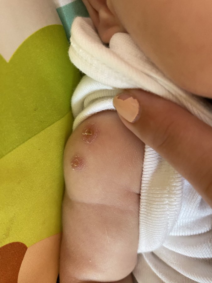 La mamá de los gemelos contó que la pediatra le dijo que posiblemente hayan vacunado dos veces al mismo bebé por error, porque uno tiene doble marca y el otro ninguna (Twitter: @sofiar388)